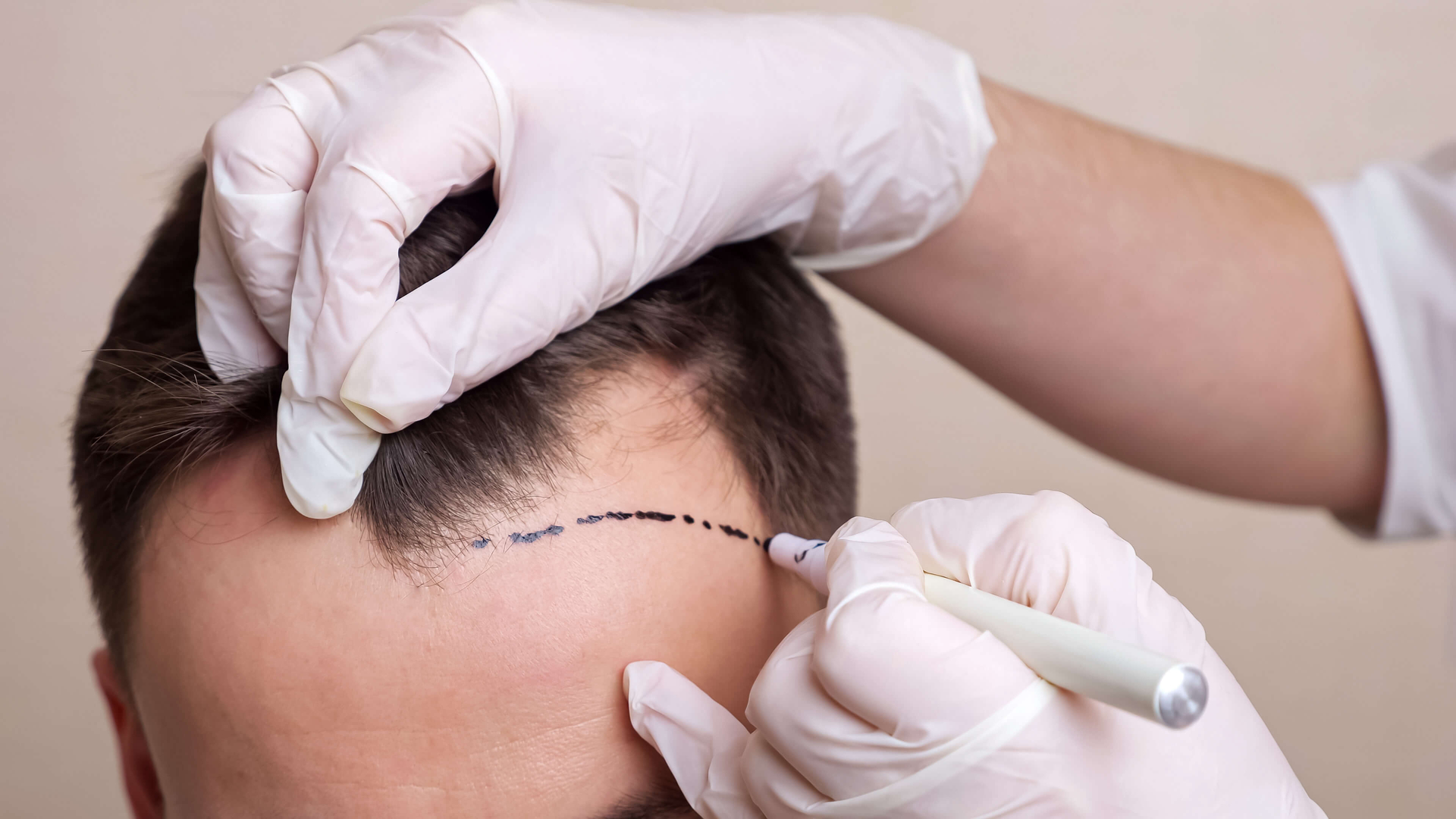 Saç Ekimi Konusunda Güvenilir Adres: Live Hair Clinic