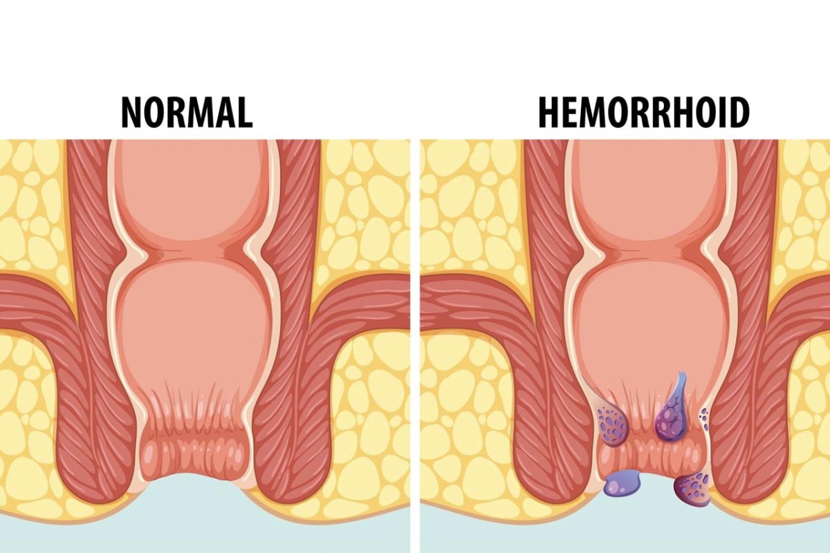 Hemoroid Belirtileri Başka Hastalıklarla Karışabiliyor: Uzmanlar Uyarıyor