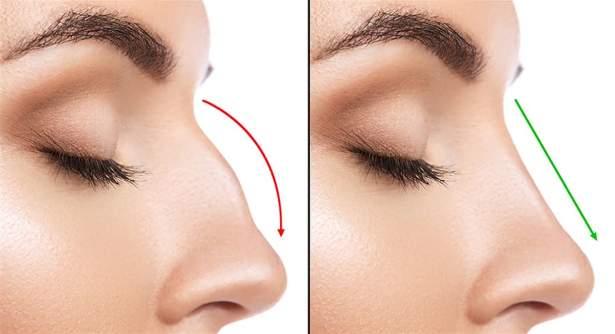 Preservation Rhinoplasty Nedir? Burun Estetiğinde Koruyucu Yaklaşım